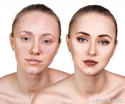 两边眉头长痘痘怎么办