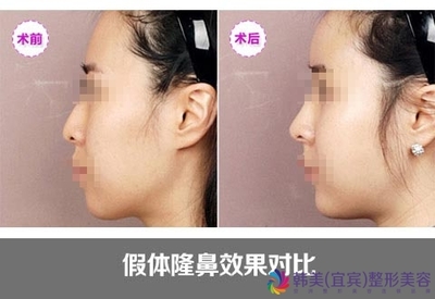 隆鼻有哪几种