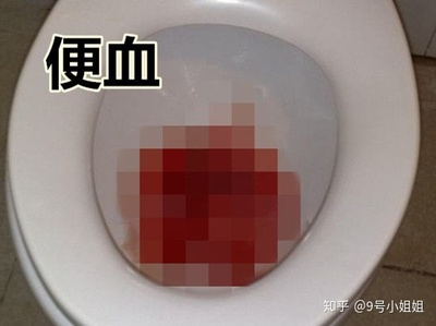 痔疮痔疮怎么治疗最好