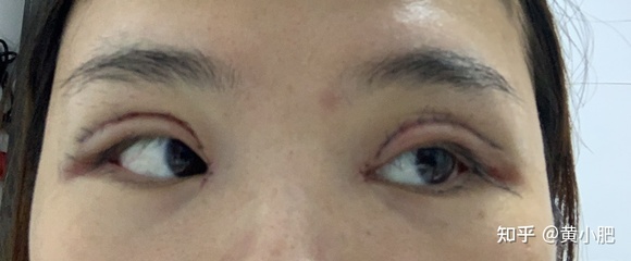 割双眼皮一个月了还需要忌口吗