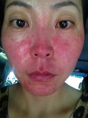 激素脸一保湿就爆痘痘