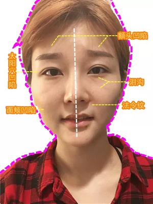 左右脸对称长痘痘