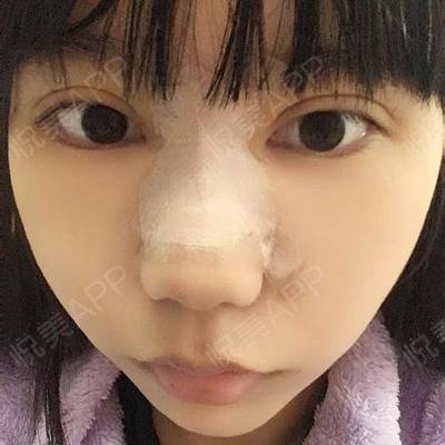 割双眼皮消炎针打几天