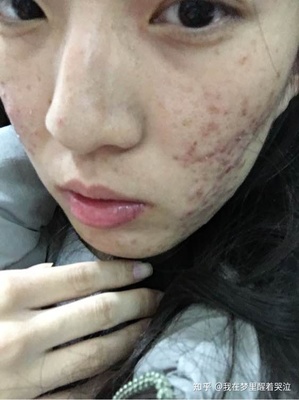 敏感肌肤痘痘发红