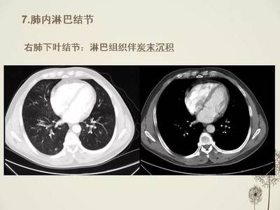 右肺下叶结节怎么治疗