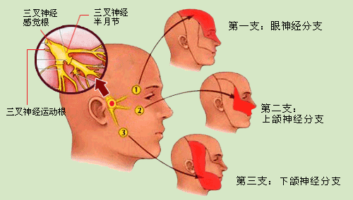 三叉神经疼是怎么回事