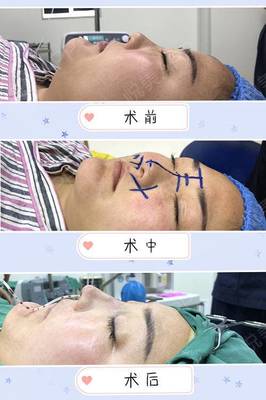 深圳注射隆鼻取出