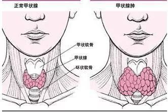 怎么治疗淋巴结节