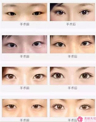 粘合双眼皮缺点
