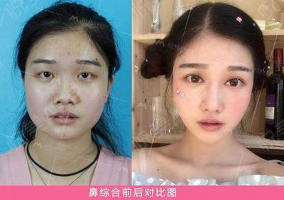 隆鼻等老了以后后遗症