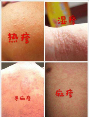 宝宝麻疹的症状和治疗