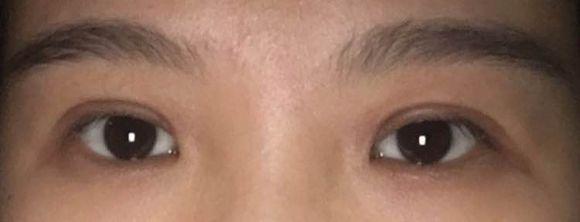 做完双眼皮多久能游泳