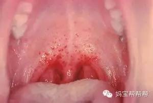 宝宝口疮图片