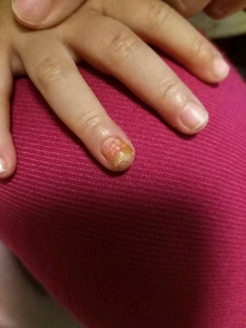 手指甲蜕皮是怎么回事