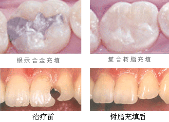 牙齿楔形缺损补牙后疼