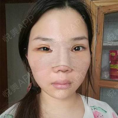隆鼻打几天消炎针