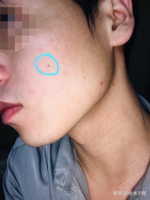 男生脸的两侧长痘痘的原因