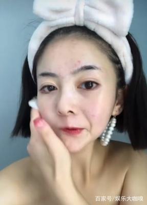 痘痘好了颜值确实提升不少