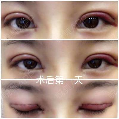 做双眼皮埋线好吗