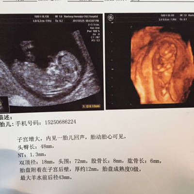 胎盘后壁几个月显怀