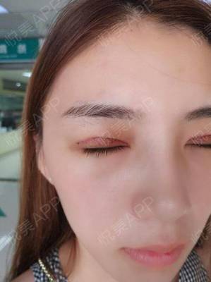 双眼皮上长了个脂肪粒