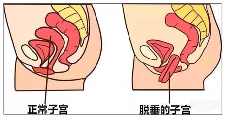 宫颈下垂怎么治疗