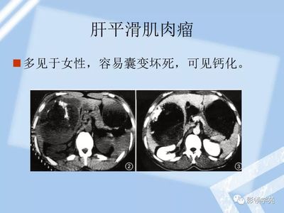 淋巴结钙化是怎么回事