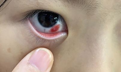 眼睛上火是怎么回事