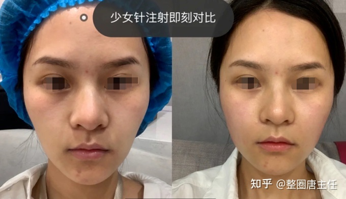 玻尿酸好吗