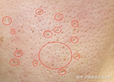 毛孔粗大痘坑