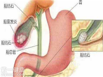 胆结石该怎么治疗