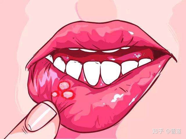 口腔黏膜溃疡怎么治疗