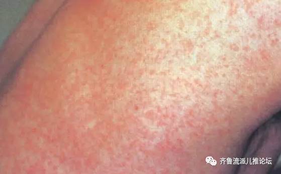 宝宝荨麻疹可以洗澡吗