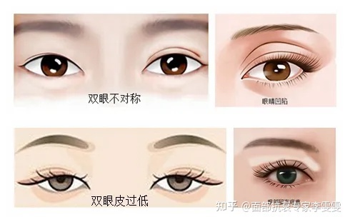眼睛凹陷可以做双眼皮吗