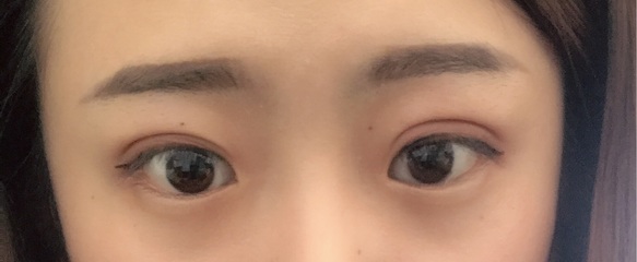 埋线双眼皮多久恢复正常