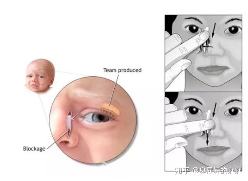 新生儿泪道堵塞的症状