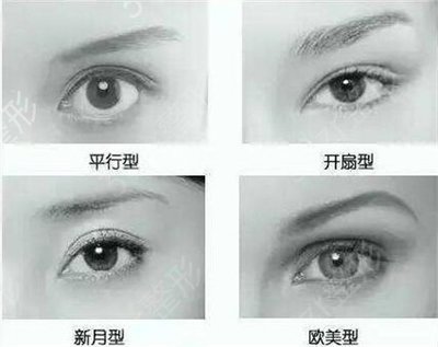 埋线双眼皮能拆吗