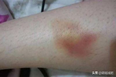 身体很容易淤青是怎么回事