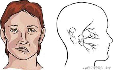 脸部麻木是怎么回事