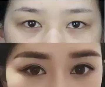 桃花眼必须是双眼皮吗