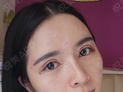 全切双眼皮拆线后注意事项