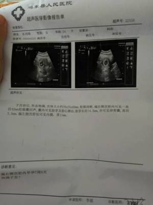 怀孕8周胎芽多大正常