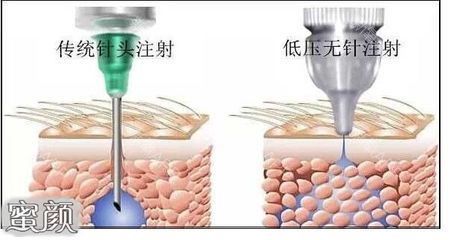 手工打水光针注意事项