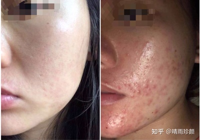 痘痘有周期吗