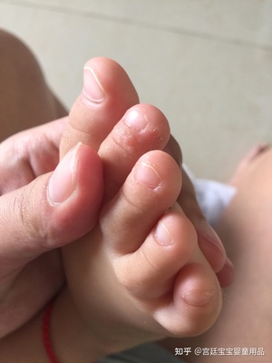 宝宝有脚气怎么办用什么药好