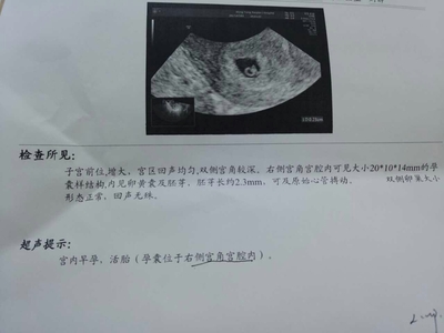 胎儿死亡赔偿标准