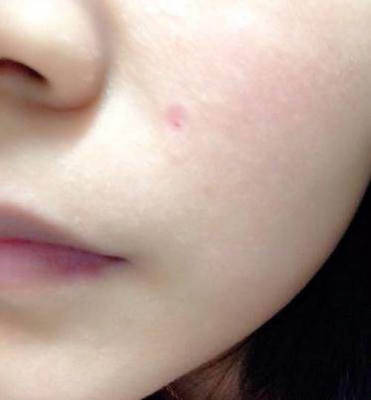 药水点痣后的恢复过程