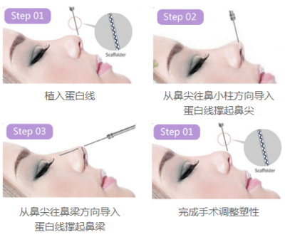 线雕隆鼻一包多少根线