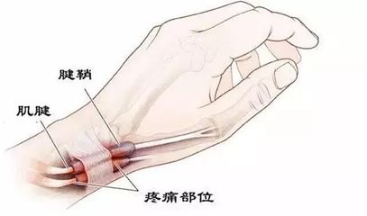 什么是腱鞘炎怎么治疗