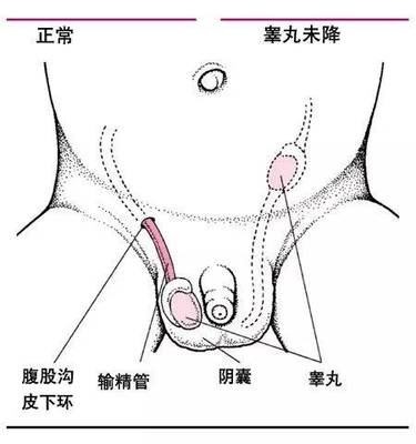 男孩隐睾是怎么回事